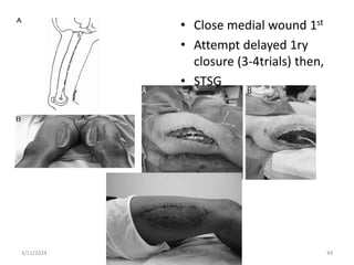 • Close medial wound 1st
• Attempt delayed 1ry
closure (3-4trials) then,
• STSG
3/11/2024 44
 
