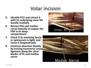 Volar incision
5. Identify FCU and retract it
with its underlying ulnar NV
bundle medially
6. Retract FDS and median
nerve laterally to expose the
FDP in its deep
compartment
7. Check if its overlying fascia
or epimysium is tight, and
incise it longitudinally
8. Continue disection distally
by incising transverse carpal
ligament along the ulnar
border of PL and median
nerve
47
3/11/2024
 