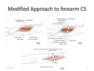 Modified Approach to forearm CS
3/11/2024 49
 