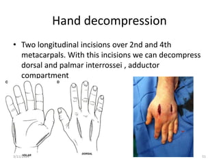 Hand decompression
• Two longitudinal incisions over 2nd and 4th
metacarpals. With this incisions we can decompress
dorsal and palmar interrossei , adductor
compartment
51
3/11/2024
 