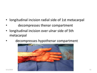 • longitudinal incision radial side of 1st metacarpal
• decompresses thenar compartment
• longitudinal incision over ulnar side of 5th
metacarpal
• decompresses hypothenar compartment
3/11/2024 53
 