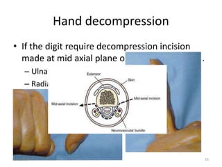 Hand decompression
55
• If the digit require decompression incision
made at mid axial plane on independent side.
– Ulnar side : middle , index and ring finger
– Radial side : little finger and thumb
3/11/2024
 