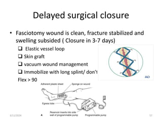 Delayed surgical closure
• Fasciotomy wound is clean, fracture stabilized and
swelling subsided ( Closure in 3-7 days)
 Elastic vessel loop
 Skin graft
 vacuum wound management
 Immobilize with long splint/ don’t
Flex > 90
3/11/2024 57
 