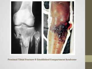Comprehensive Overview of Compartment Syndrome: Causes, Diagnosis ...
