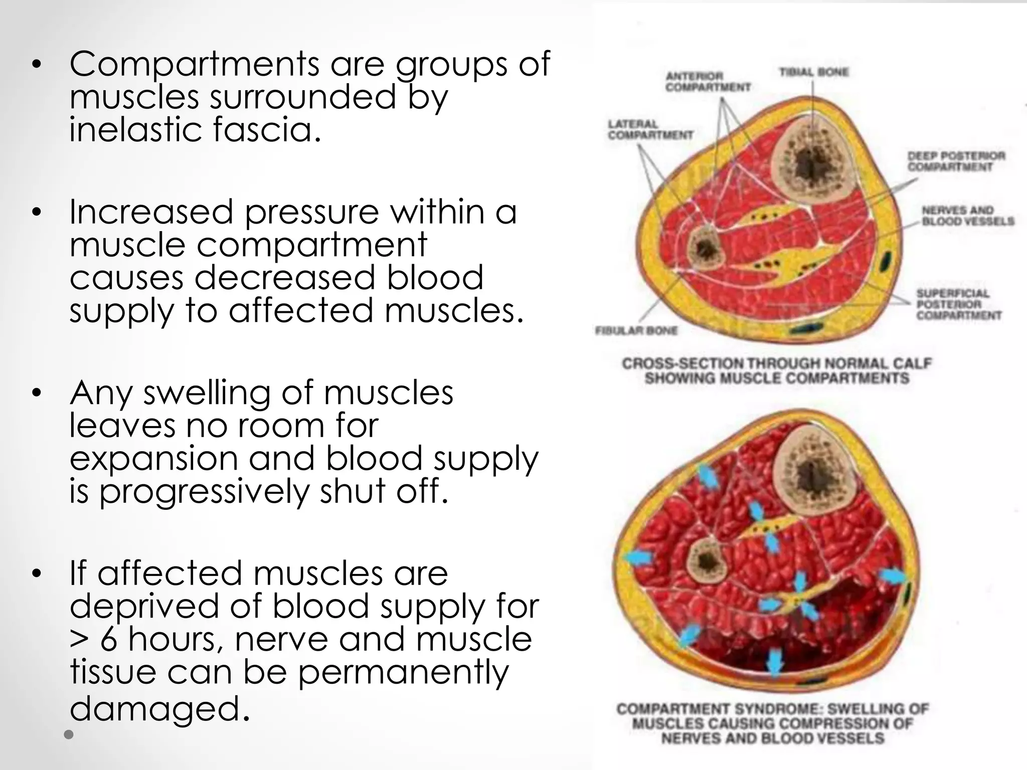 Compartment Syndrome | PPTX