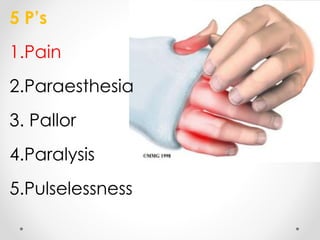 5 P’s
1.Pain
2.Paraesthesia
3. Pallor
4.Paralysis
5.Pulselessness
 