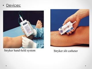• Devices:
Stryker hand-held system Stryker slit catheter
 