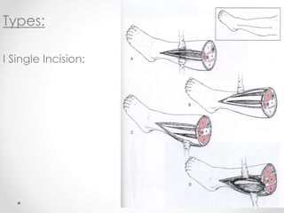 Types:
I Single Incision:
 