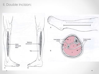II. Double Incision:
 
