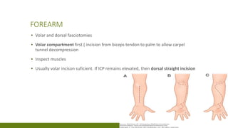 Dorsal Racket Incision Compartment syndrome | PPTX
