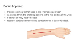 Dorsal Approach
● Incision is similar to that used in the Thompson approach
● can extend from the lateral epicondyle to the mid-portion of the wrist
● Full incision may not be needed
● fascia of dorsal and mobile wad compartments is easily released.
 