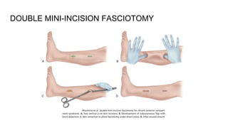 DOUBLE MINI-INCISION FASCIOTOMY
 