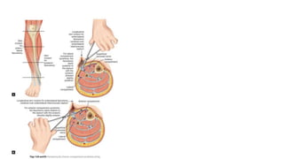 COMPARTMENT SYNDROME  