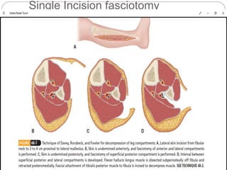 Single Incision fasciotomy
 