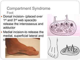 Compartment Syndrome
Foot
 Dorsal incision- (placed over
1st and 3rd web space)to
release the interosseous and
adductor
 Medial incision-to release the
medial, superficial lateral and
calcaneal compartments
 