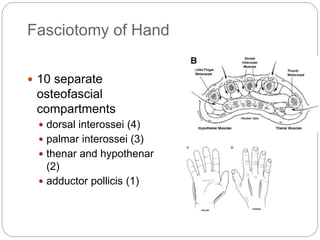 Fasciotomy of Hand
 10 separate
osteofascial
compartments
 dorsal interossei (4)
 palmar interossei (3)
 thenar and hypothenar
(2)
 adductor pollicis (1)
 