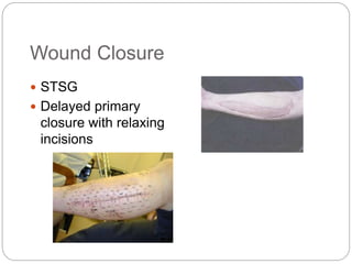 Wound Closure
 STSG
 Delayed primary
closure with relaxing
incisions
 