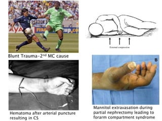 Blunt Trauma-2nd MC cause
Mannitol extravasation during
partial nephrectomy leading to
forarm compartment syndrome
Hematoma after arterial puncture
resulting in CS
 