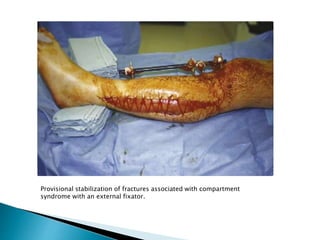 Provisional stabilization of fractures associated with compartment
syndrome with an external fixator.
 