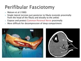  Matsen et al (1980)
 Single lateral incision just posterior to fibula (extends proximally
from the head of the fibula and distally to the ankle)
 Expose and protect Common Peroneal Nerve proximally
 More difficult for decompression of deep compartment
 