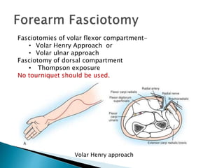 Fasciotomies of volar flexor compartment-
• Volar Henry Approach or
• Volar ulnar approach
Fasciotomy of dorsal compartment
• Thompson exposure
No tourniquet should be used.
Volar Henry approach
 