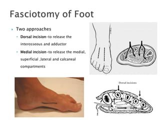  Two approaches
• Dorsal incision-to release the
interosseous and adductor
• Medial incision-to release the medial,
superficial ,lateral and calcaneal
compartments
 