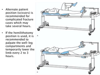 • Alternate patient
position (scissors) is
recommended for
complicated fracture
cases which may
take several hours.
• If the hemilithotomy
position is used, it is
recommended to
palpate the well-leg
compartments and
temporarily lower the
limb every 2 to 3
hours.
 