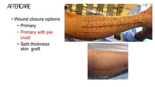 Compartment Syndrome Student Class.pdf