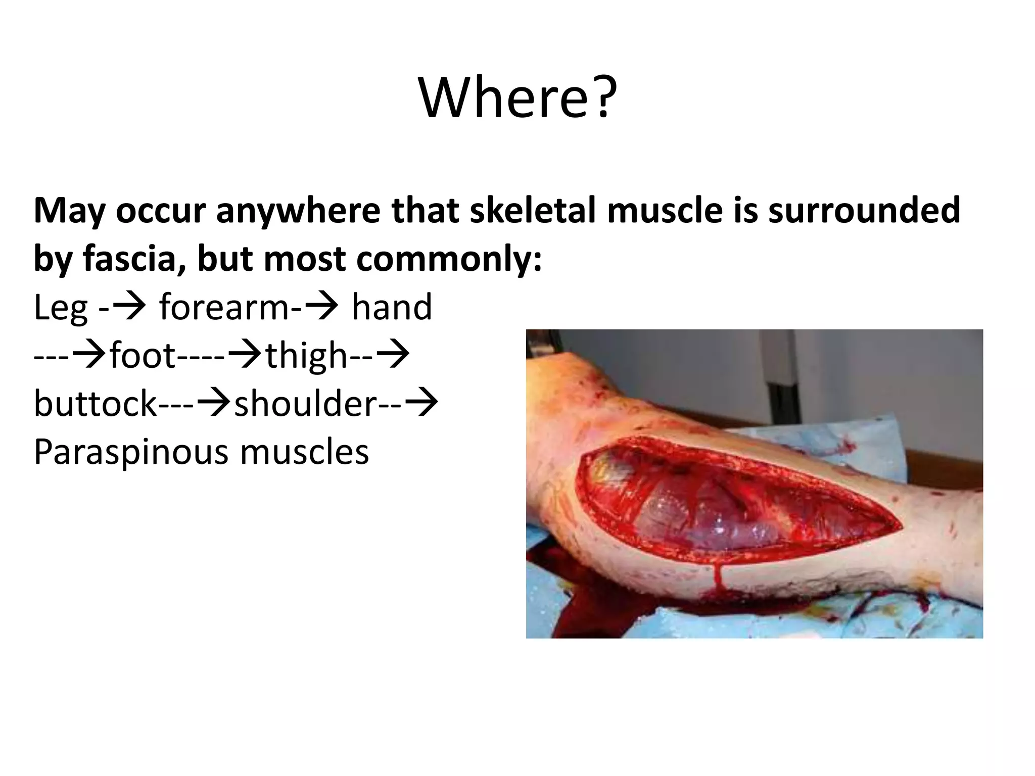 Compartment syndrome teaching | PPTX