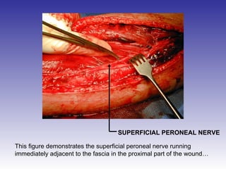 SUPERFICIAL PERONEAL NERVE 
This figure demonstrates the superficial peroneal nerve running 
immediately adjacent to the fascia in the proximal part of the wound… 
 