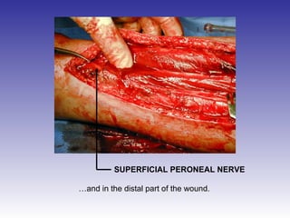 SUPERFICIAL PERONEAL NERVE 
…and in the distal part of the wound. 
 
