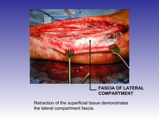 FASCIA OF LATERAL 
COMPARTMENT 
Retraction of the superficial tissue demonstrates 
the lateral compartment fascia. 
 