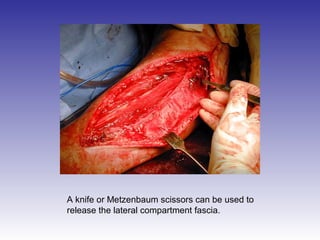 A knife or Metzenbaum scissors can be used to 
release the lateral compartment fascia. 
 