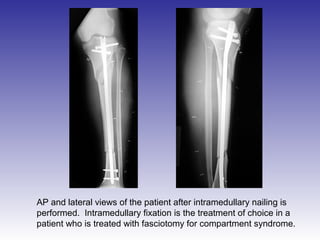 AP and lateral views of the patient after intramedullary nailing is 
performed. Intramedullary fixation is the treatment of choice in a 
patient who is treated with fasciotomy for compartment syndrome. 

