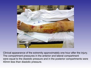 Clinical appearance of the extremity approximately one hour after the injury. 
The compartment pressures in the anterior and lateral compartment 
were equal to the diastolic pressure and in the posterior compartments were 
40mm less than diastolic pressure. 
 