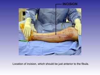INCISION 
Location of incision, which should be just anterior to the fibula. 
 