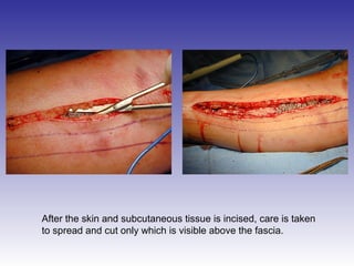 After the skin and subcutaneous tissue is incised, care is taken 
to spread and cut only which is visible above the fascia. 
 