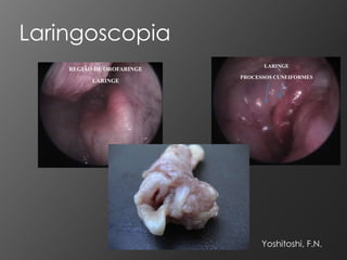 Laringoscopia
                                 LARINGE
    REGIÃO DE OROFARINGE
                           PROCESSOS CUNEIFORMES
          LARINGE




                                 Yoshitoshi, F.N.
 