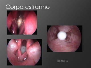 Corpo estranho




                 YOSHITOSHI, F.N.
 