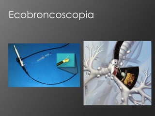 Ecobroncoscopia
 