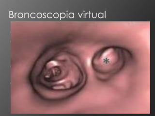Broncoscopia virtual
 Método de avaliação das vias aéreas
 Baseado em imagens obtidas através
  de tomografia computadorizada
  helicoidal
 Via software com imagens
  tridimensionais de alta resolução
 Simulando achados broncoscópicos.
 