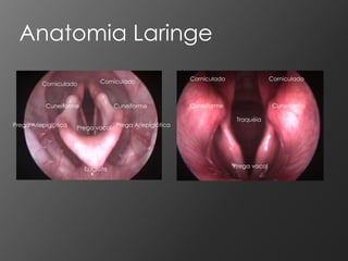 Anatomia Laringe
                             Corniculado                Corniculado                 Corniculado
          Corniculado


           Cuneiforme              Cuneiforme           Cuneiforme                   Cuneiforme

                                                                       Traquéia
Prega Ariepiglótica   Prega vocal Prega Ariepiglótica




                        Epiglote                                      Prega vocal
 