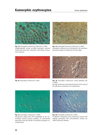 Eumorphic Rbc Compendium urinalysis | PDF