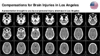 Compensations for Brain Injuries in Los Angeles
A presentation brought to you by our personal injury attorneys in Los Angeles
1
 