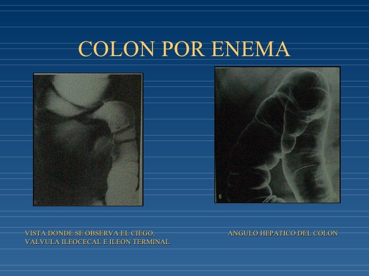 preparacion para colon por enema doble contraste