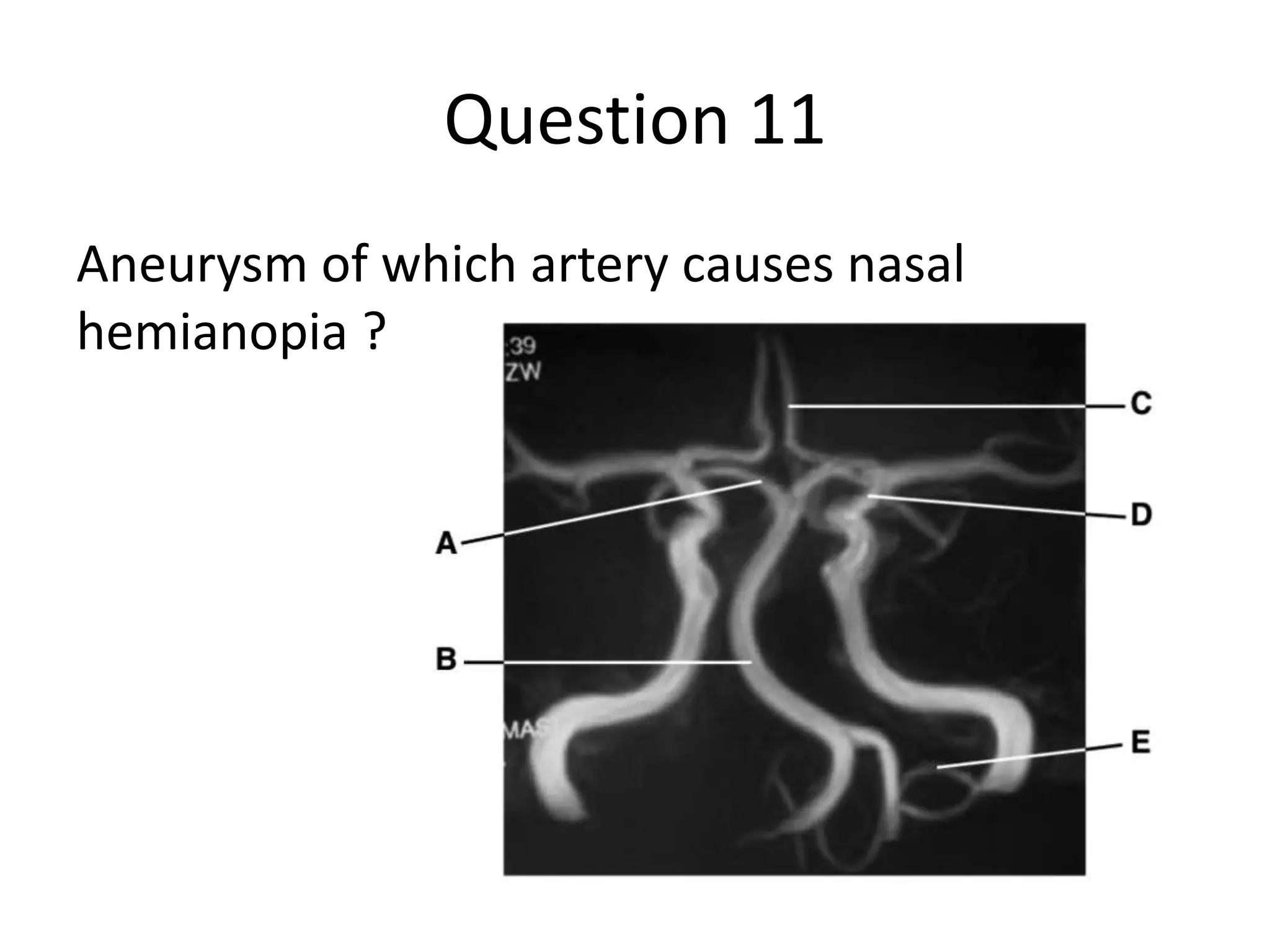 Question 11
Aneurysm of which artery causes nasal
hemianopia ?

 