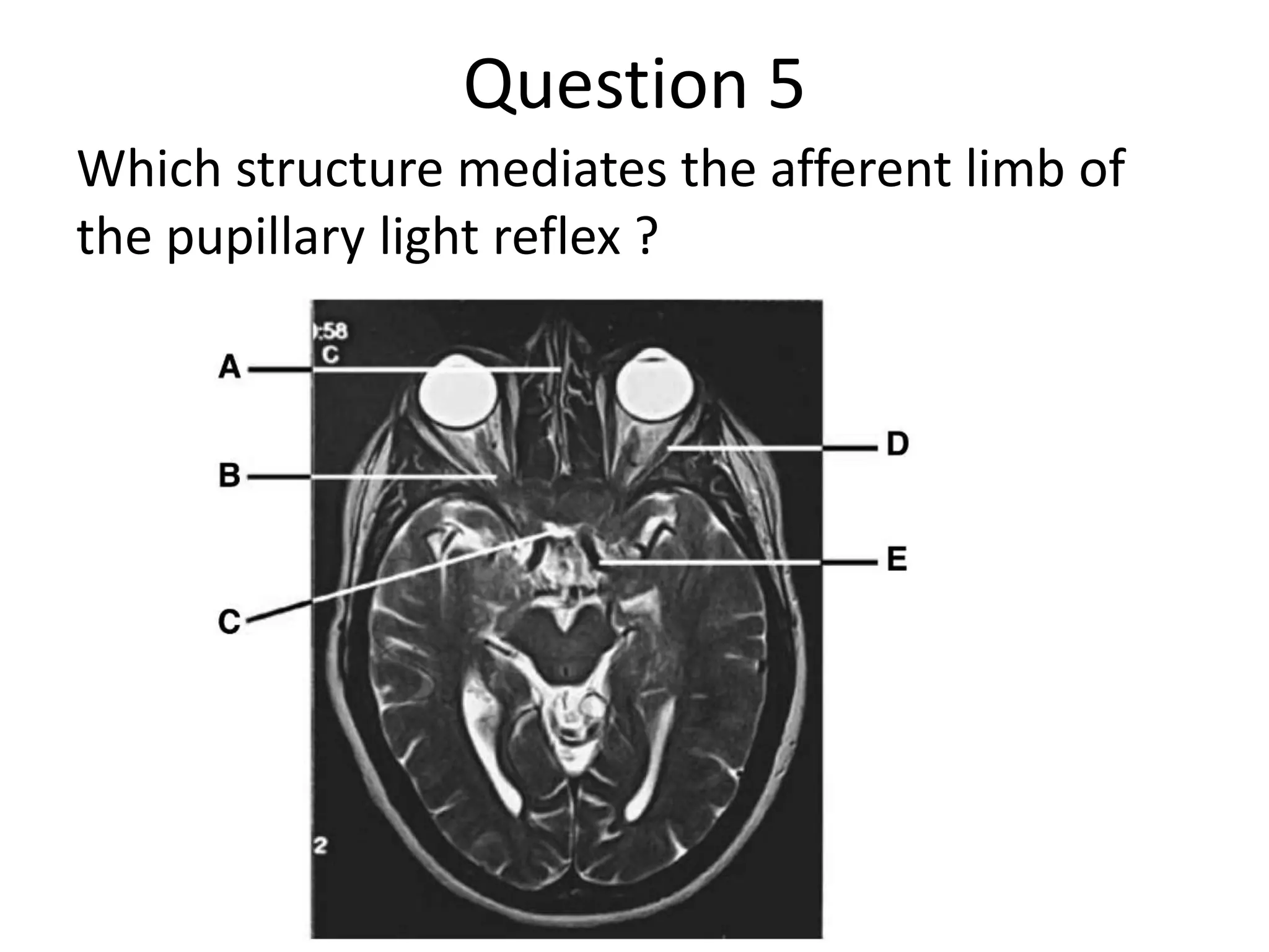 Question 5
Which structure mediates the afferent limb of
the pupillary light reflex ?

 
