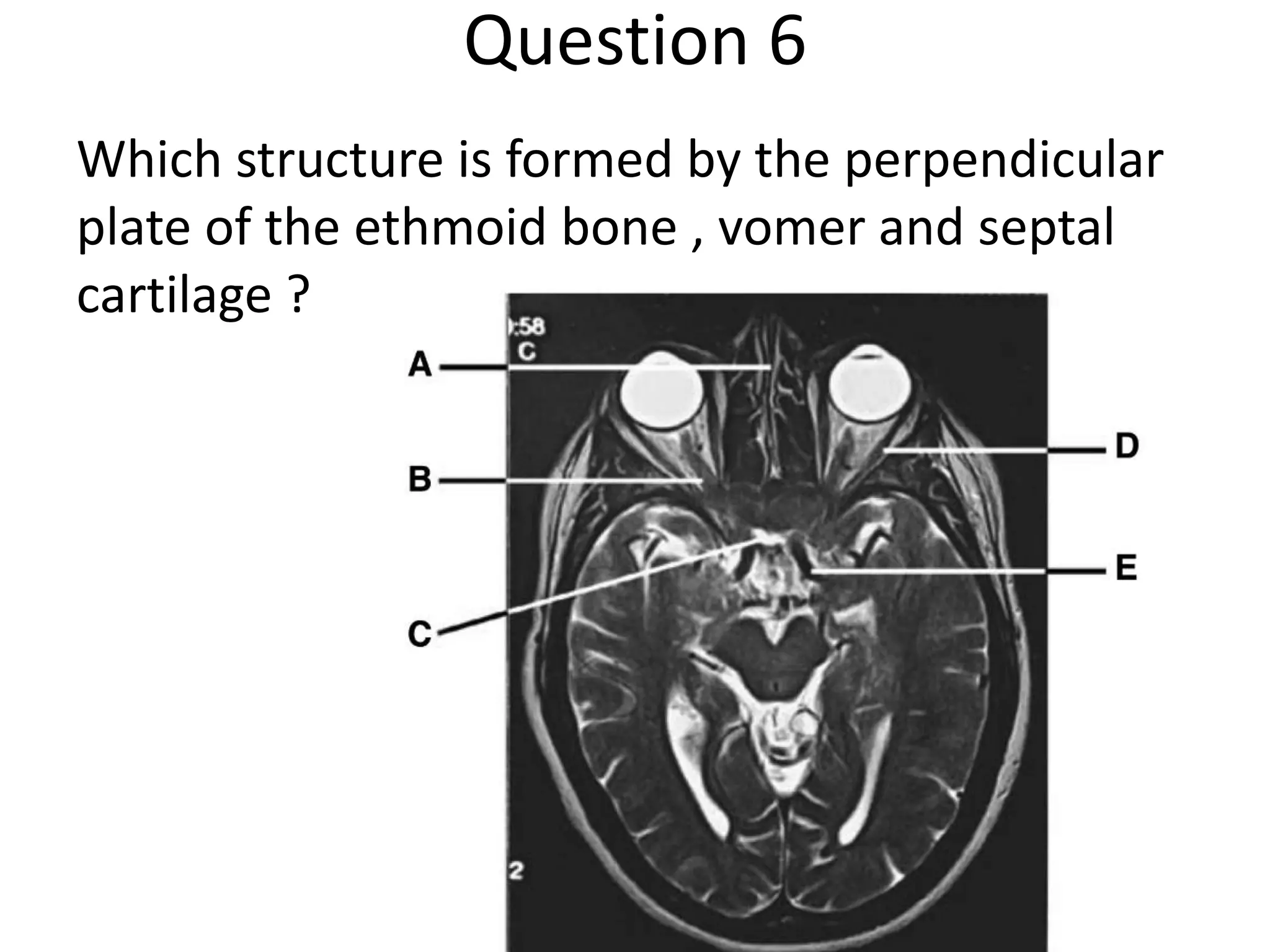 Question 6
Which structure is formed by the perpendicular
plate of the ethmoid bone , vomer and septal
cartilage ?

 