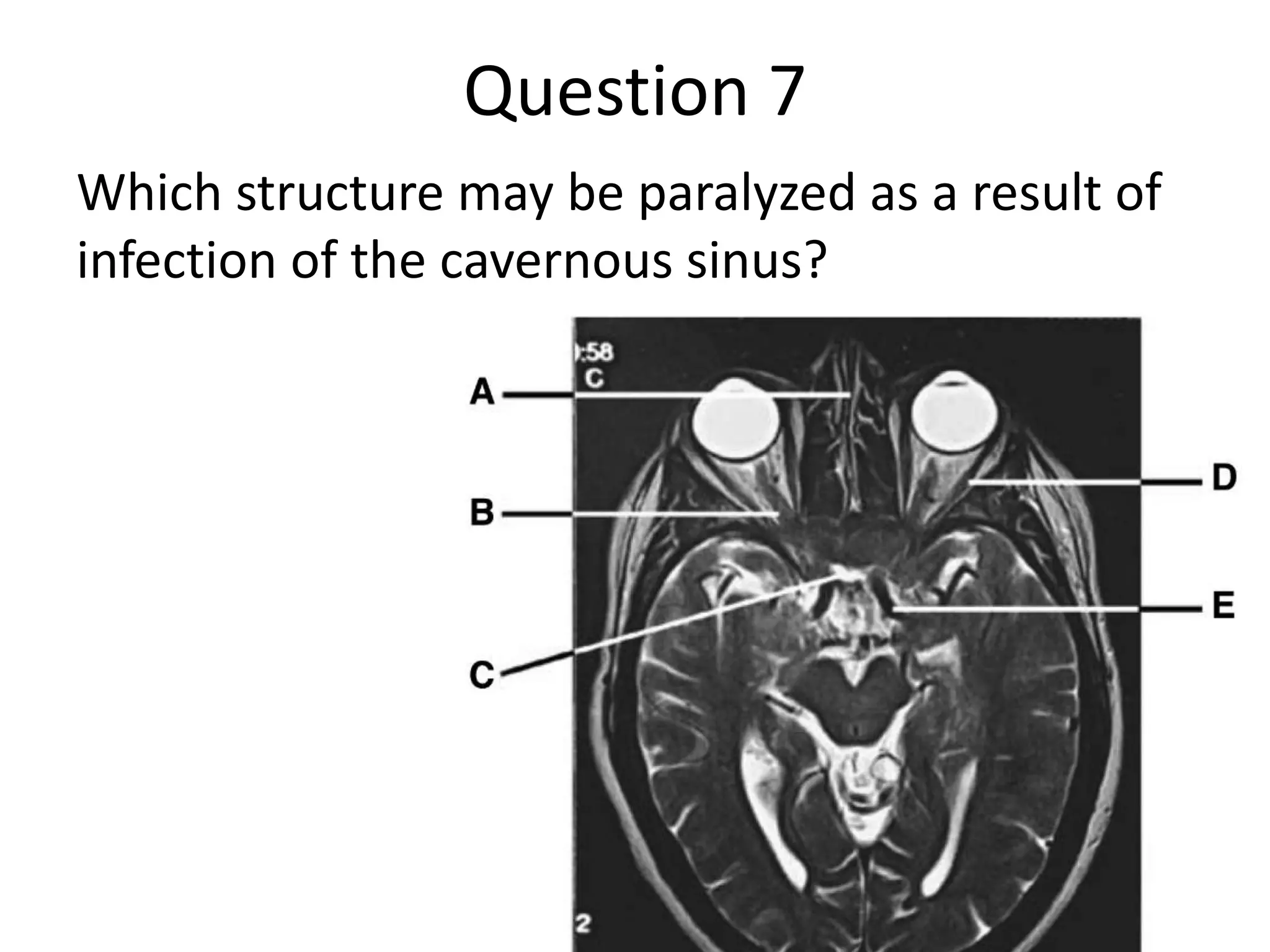 Question 7
Which structure may be paralyzed as a result of
infection of the cavernous sinus?

 