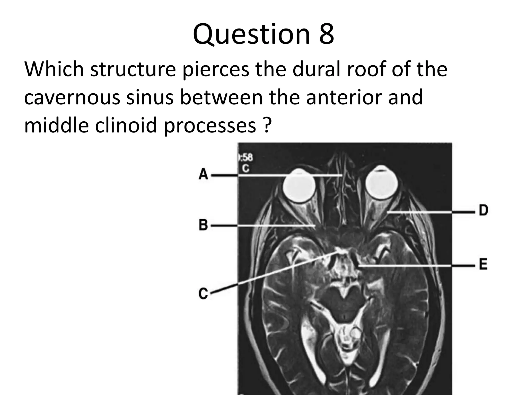 Question 8
Which structure pierces the dural roof of the
cavernous sinus between the anterior and
middle clinoid processes ?

 